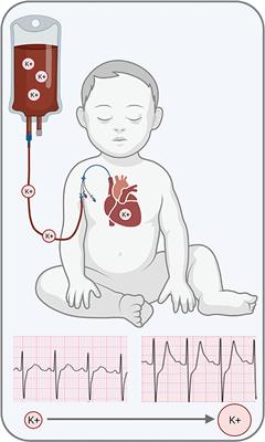 Transfusion-Associated Hyperkalemic Cardiac Arrest in Neonatal, Infant, and Pediatric Patients